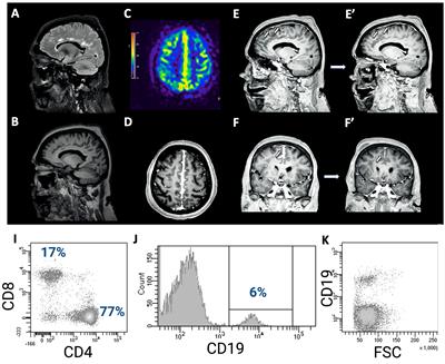 Case report: Breaking CNS immuno-privilege: TNFα-inhibitor triggers aseptic meningitis in a patient with rheumatoid arthritis